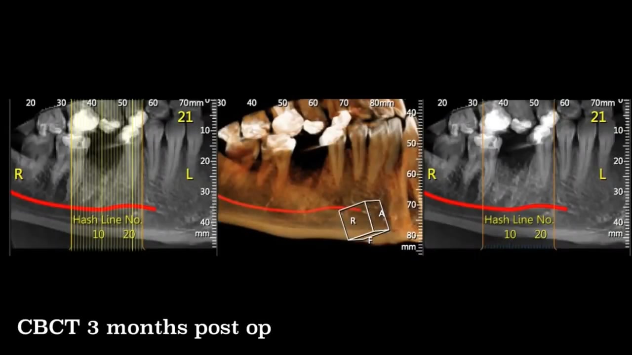 Bond Apatite® - Socket Grafting With Collagen Sponge | VIDEO - Augma ...