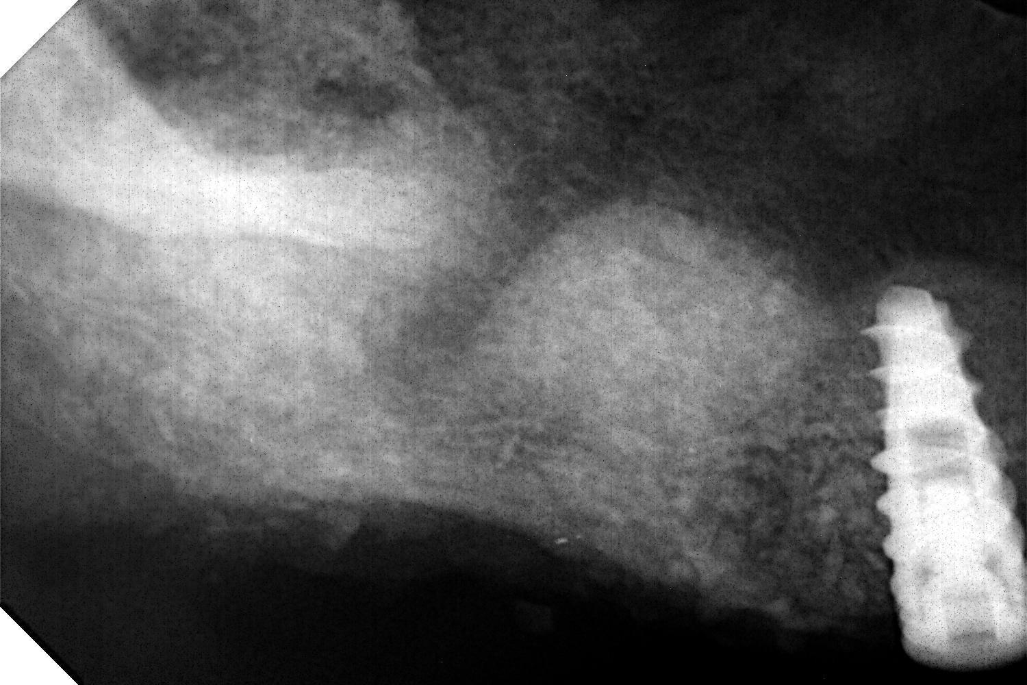What to Expect Augma Lift™ - Augma Biomaterials