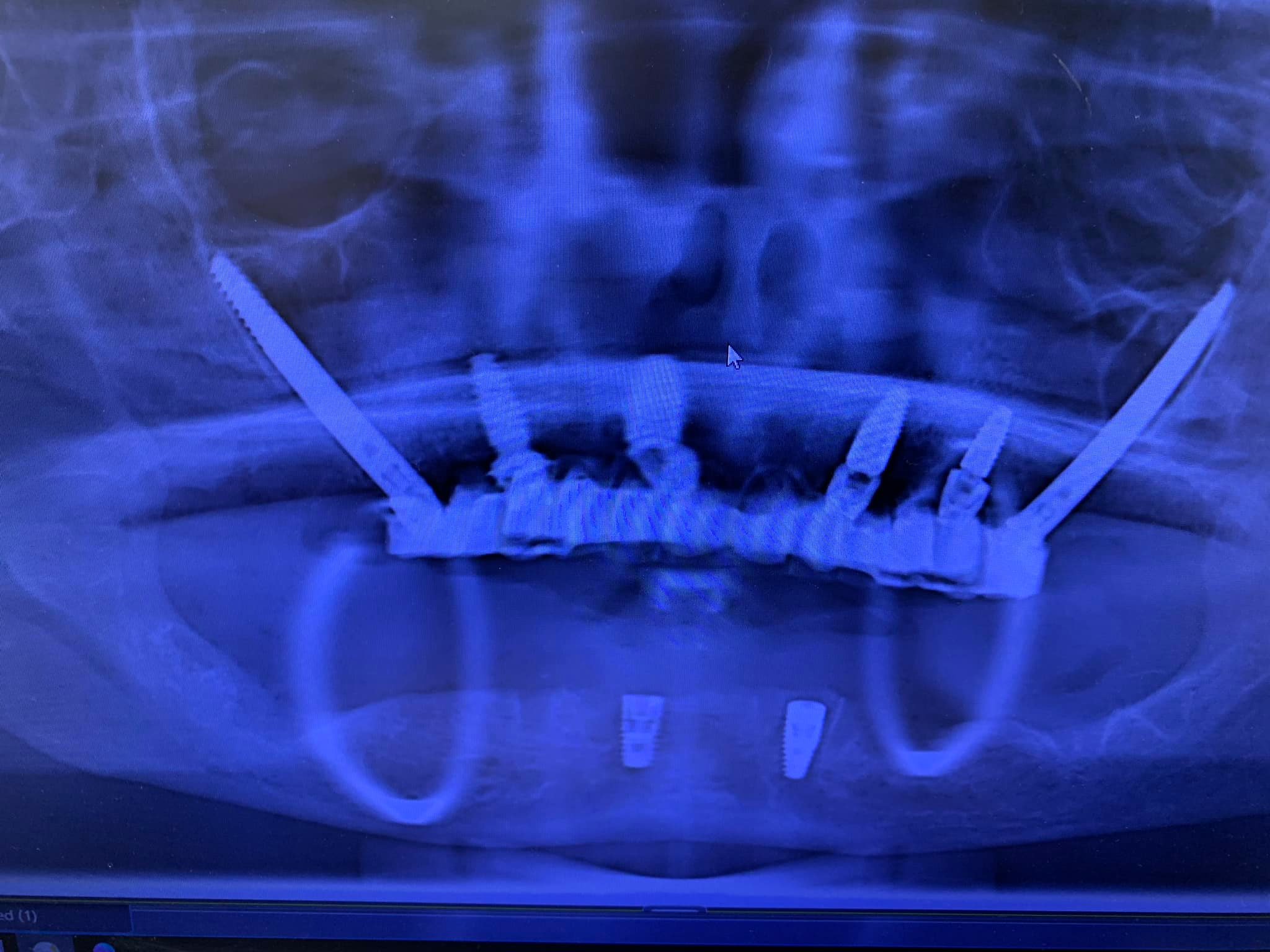 Ridge Reconstruction and Implant Placement with Augma Bond Apatite ...