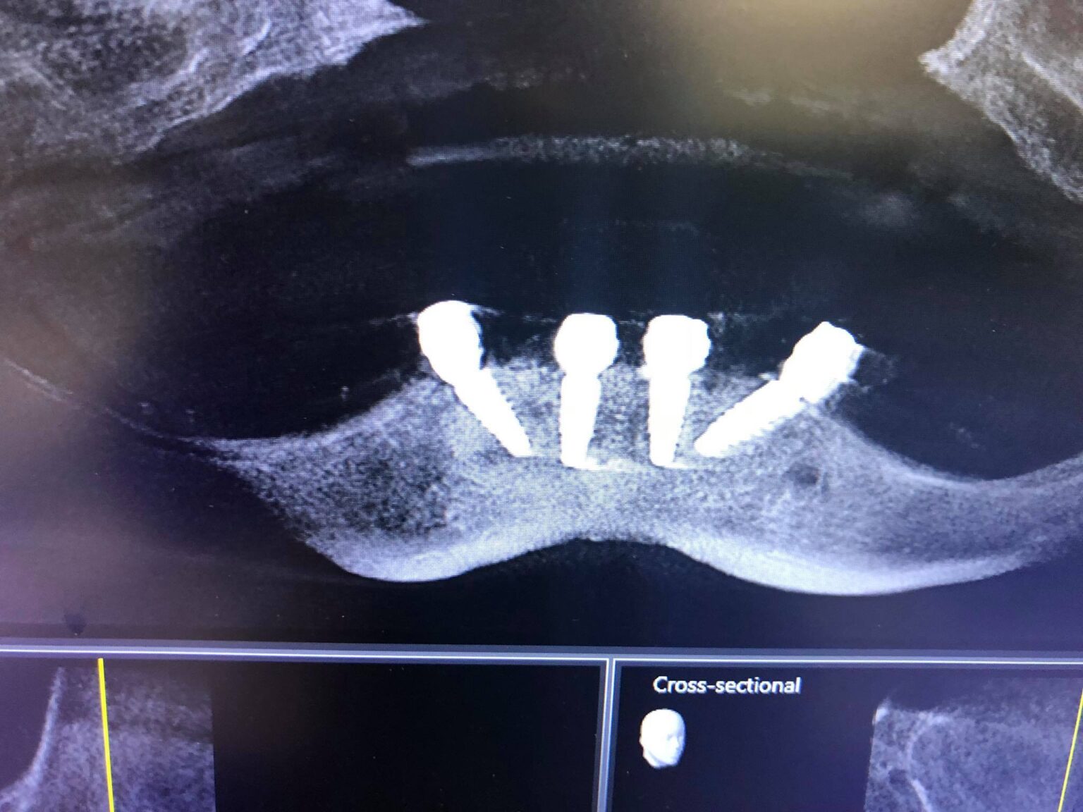 Ridge Reconstruction and Implant Placement - Augma Biomaterials