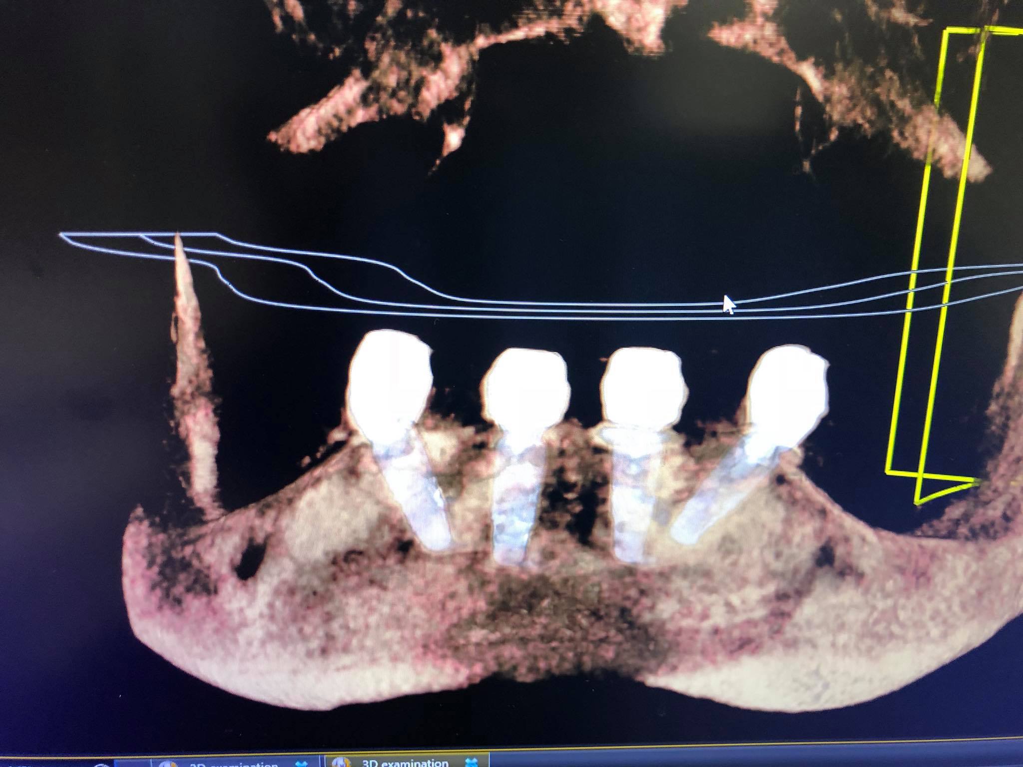 Ridge Reconstruction and Implant Placement - Augma Biomaterials