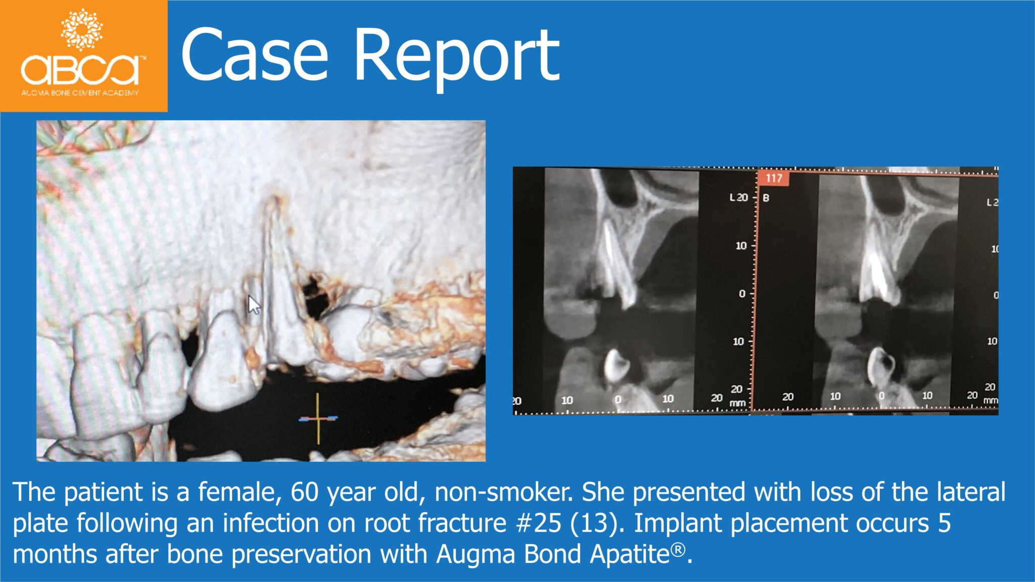 Lateral Plate Preservation with Augma Bond Apatite - Augma Biomaterials