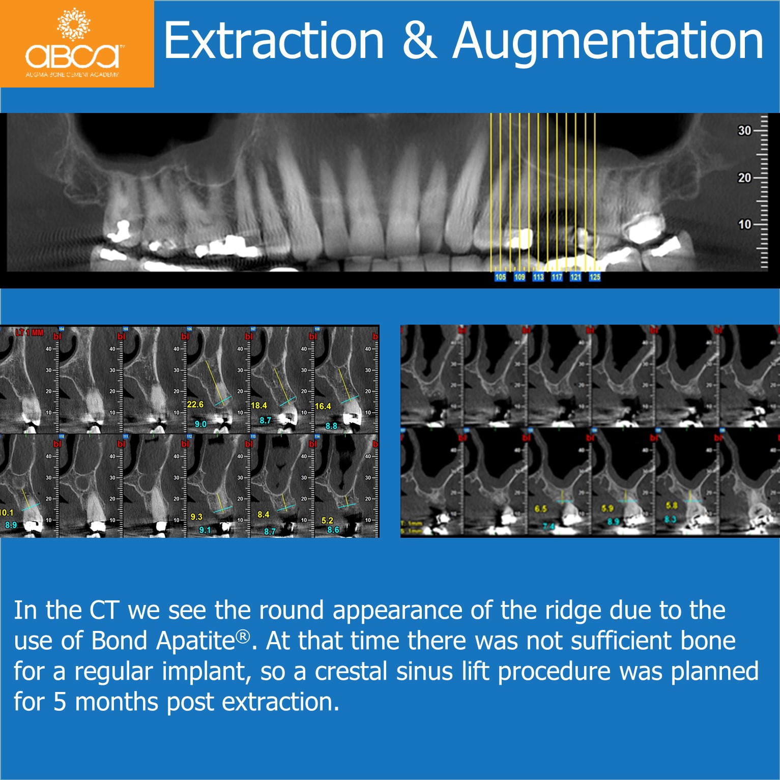 Single Tooth Loss Beneath the Maxillary Sinus - Augma Biomaterials