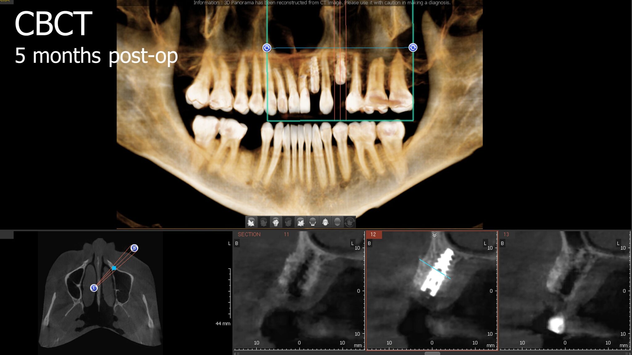 Horizontal Bone Augmentation - Immediate Implant Placement - Augma ...
