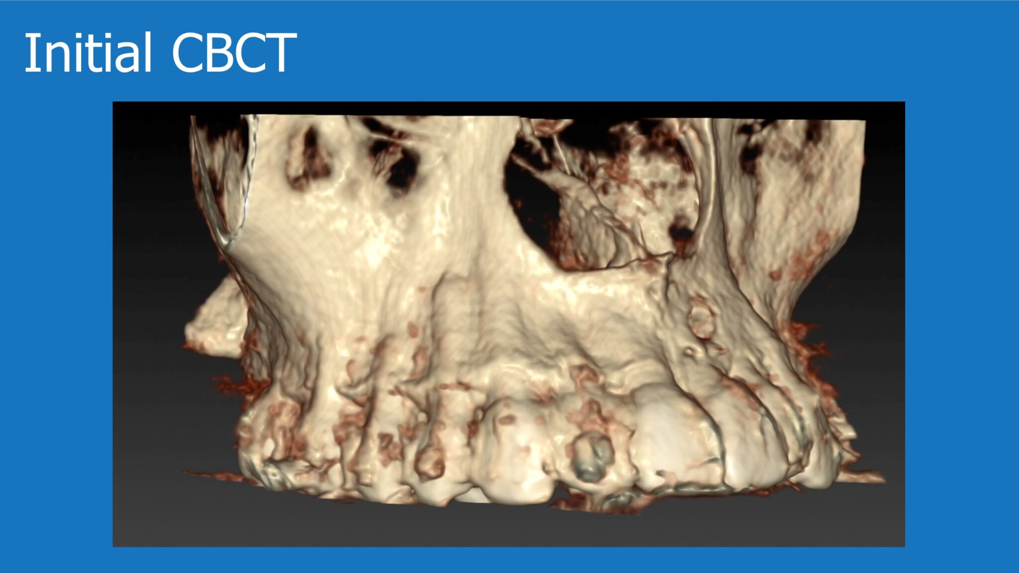 Horizontal Bone Augmentation - Immediate Implant Placement - Augma ...