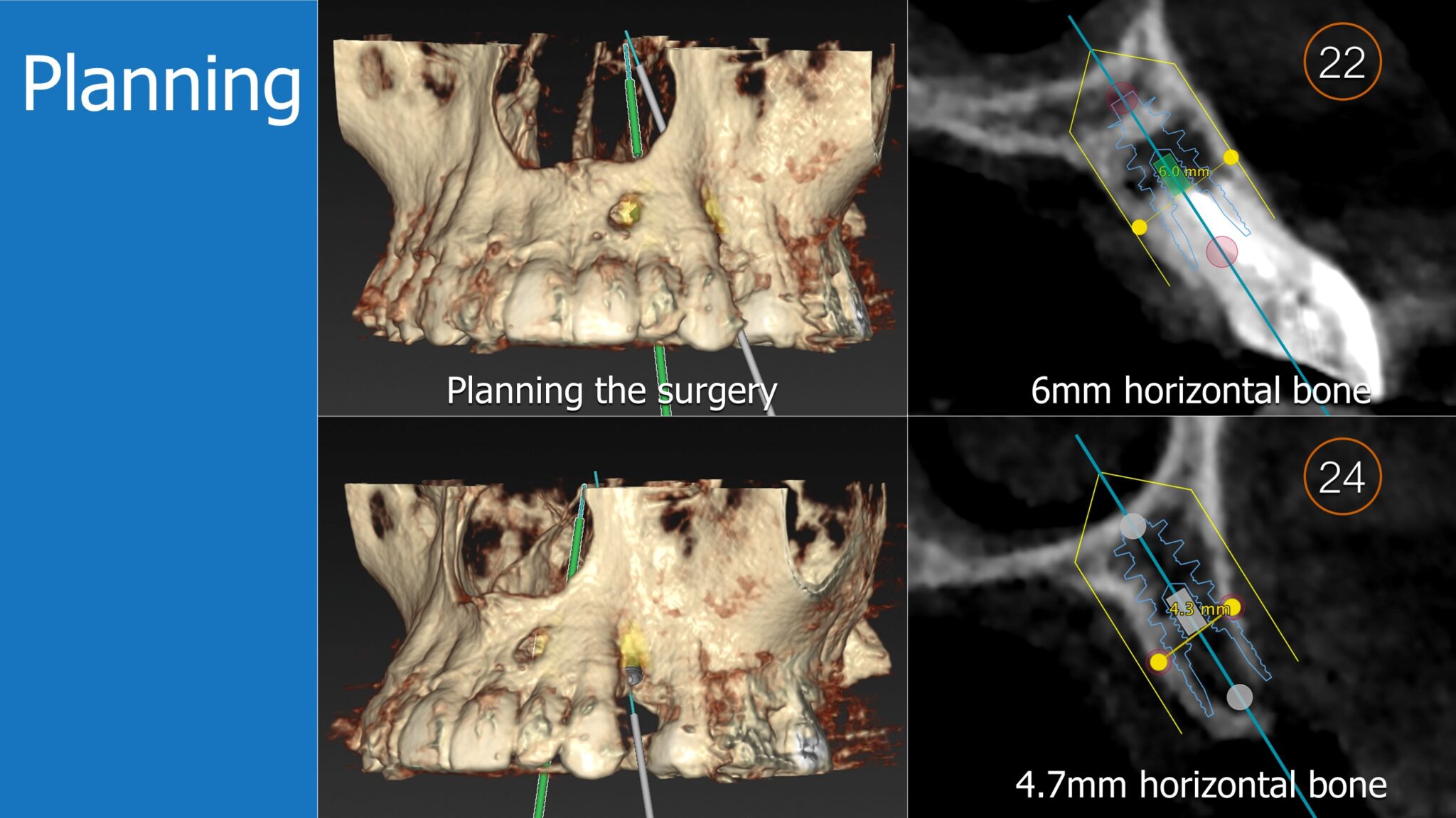Horizontal Bone Augmentation - Immediate Implant Placement - Augma ...