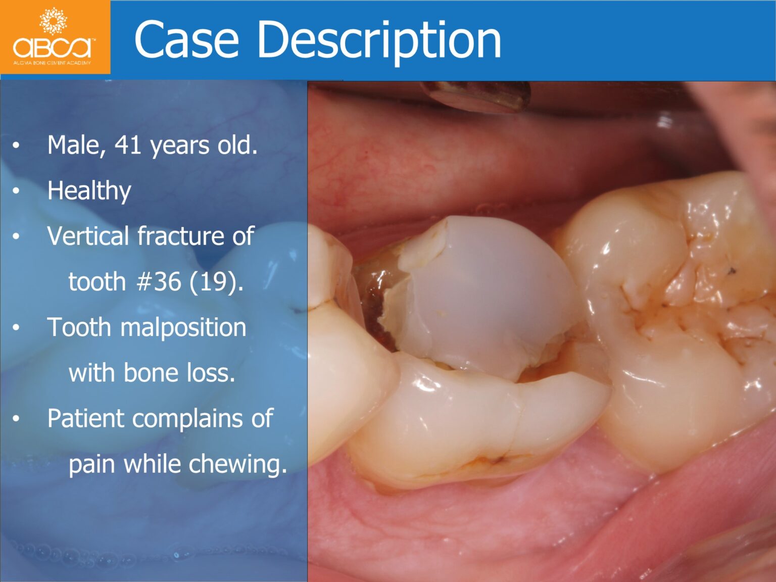 Immediate Posterior Implant with Bone Graft - Augma Biomaterials