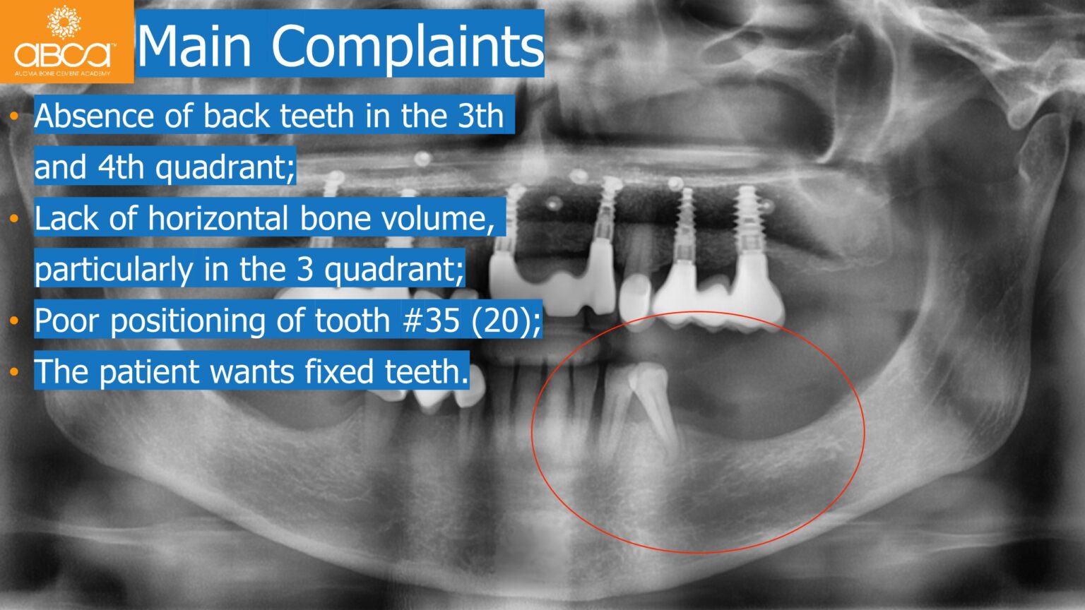 Horizontal Bone and Soft Tissue Augmentation with Augma Bond Apatite ...