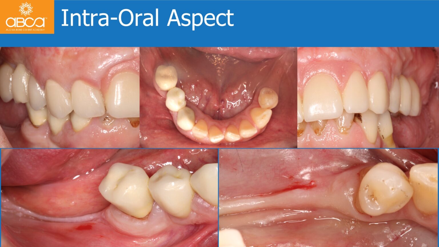 Horizontal Bone and Soft Tissue Augmentation with Augma Bond Apatite ...