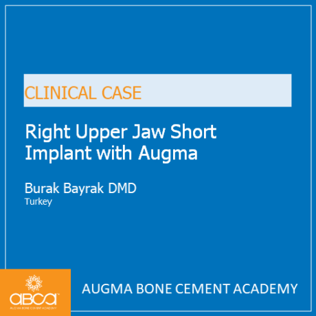 Right Upper Jaw Short Implant with Augma - Augma Biomaterials